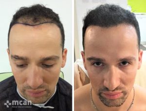 FUE hair transplant in Turkey Before After 7