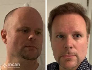 FUE hair transplant in Turkey Before After 8