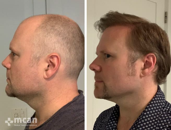 Fue hair transplant Turkey before and after