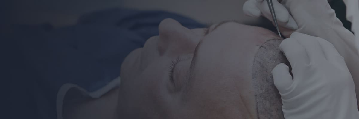 Turkey Istanbul MCAN Health - Fue Hair Transplant