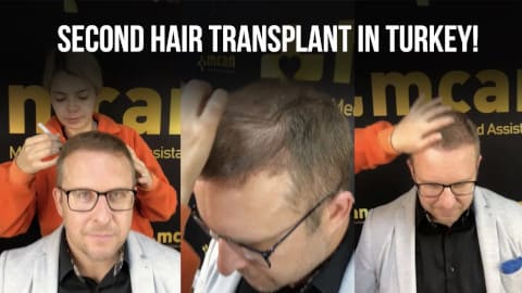 James' 2nd visit to MCAN for FUE Hair Transplant
