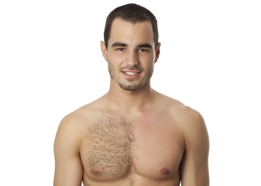 Body Hair Transplant in Turkey, Istanbul - MCAN Health Body Hair Transplant in Turkey, Istanbul - MCAN Health