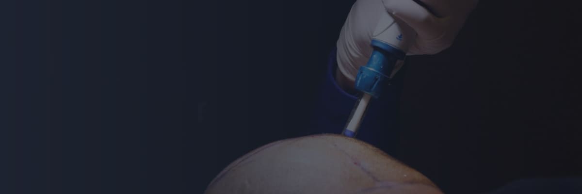Needle Free Hair Transplant Turkey