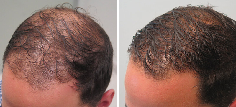 Finasteride for Hair Loss: Effects&Side Effects