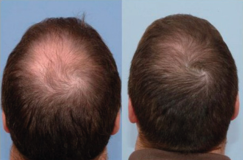 Finasteride for hair loss before and after 