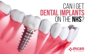 Can I Get Dental Implants on the NHS?