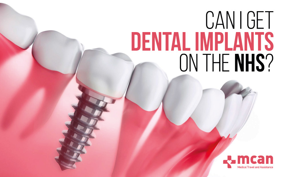 Dental implants on NHS