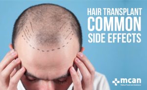 Side effects of hair transplant