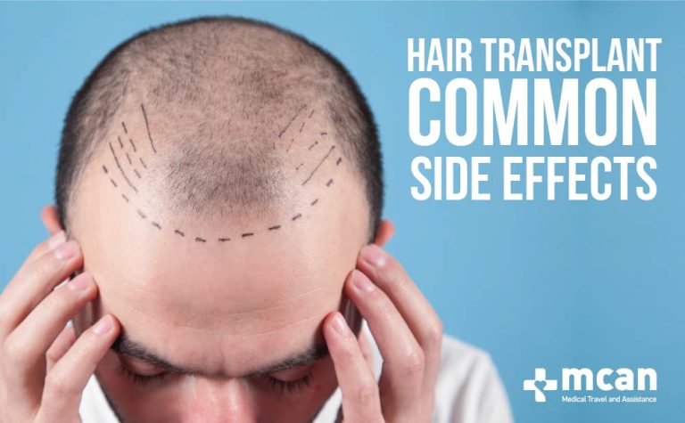 7 Common Hair Transplant Side Effects 4 Side Effects WEB 1 Side effects of hair transplant