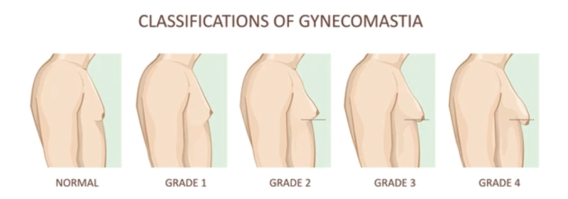 stages of gyno