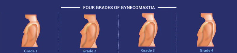 Different stages of gyno 