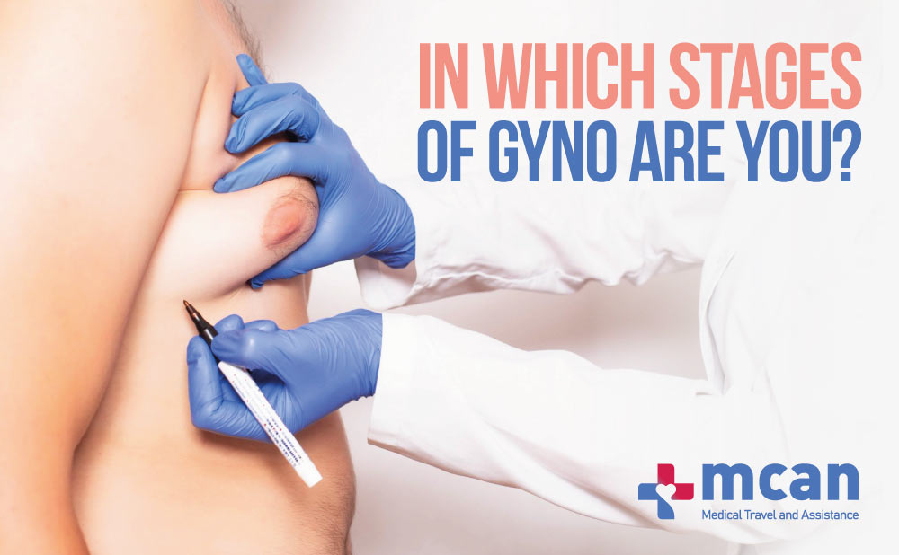 stages of gyno