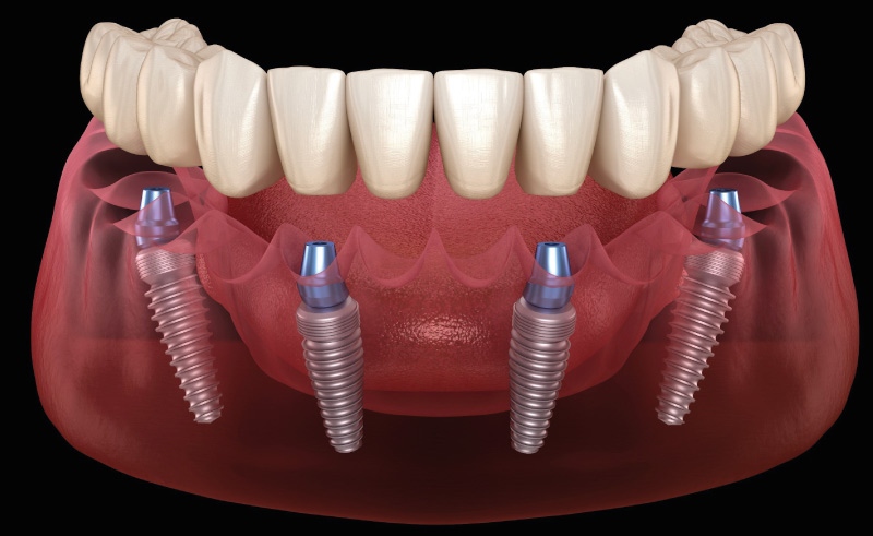 All-on-4 dental implants on NHS