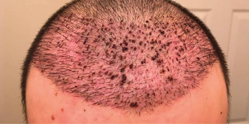 Hair Transplant Side Effects