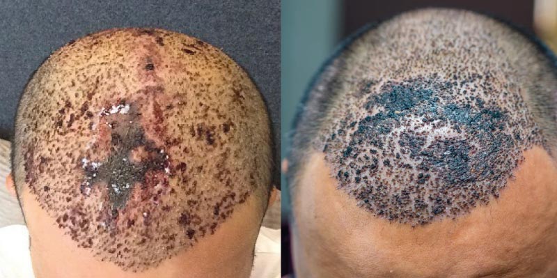 Hair Transplant Side Effects: Necrosis