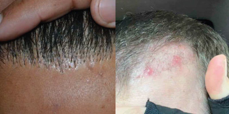Pitting and acnea as hair transplant side effects
