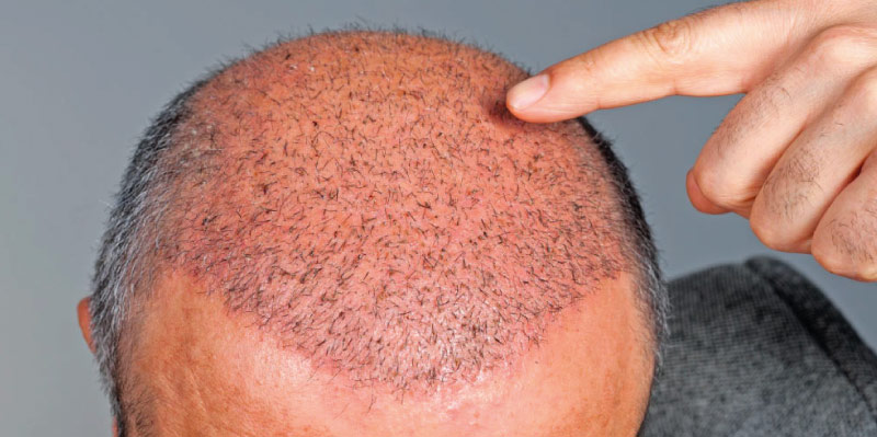 Hair Transplant Side Effects, Hair Shedding