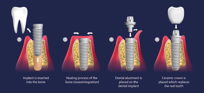side effects of dental implants 