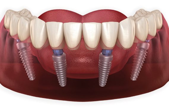 Serene Can Titanium Implants Cause Cancer View Concept Serene Can Titanium Implants Cause Cancer View Concept