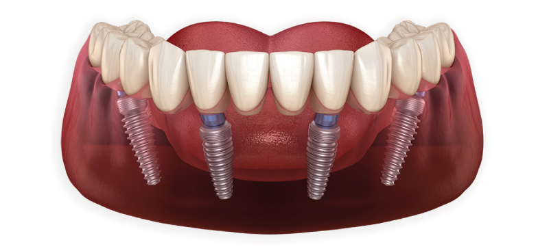 all-on 4 dental implants side effects