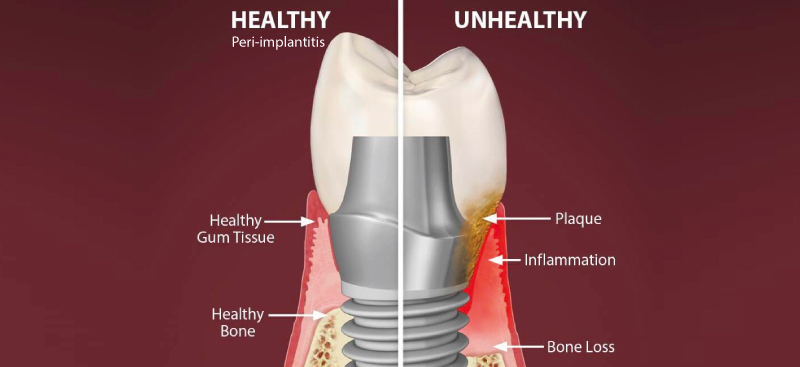 Dental Implants Side Effects: Peri-implantitis