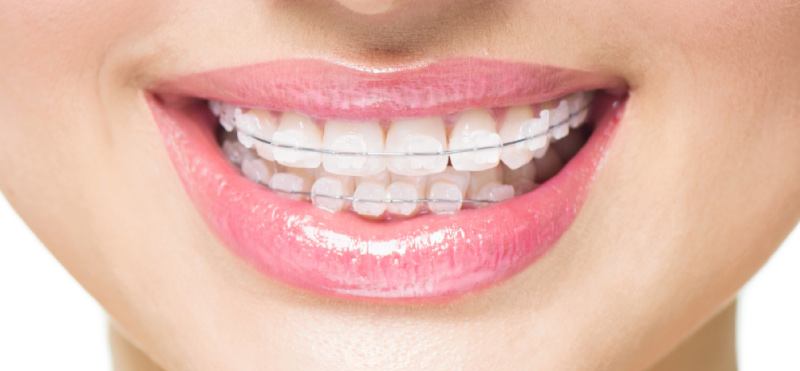 transparent teeth braces