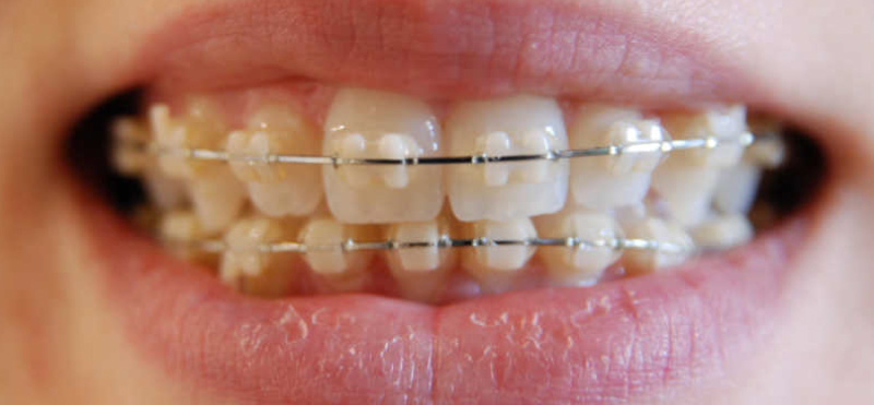 transparent dental braces