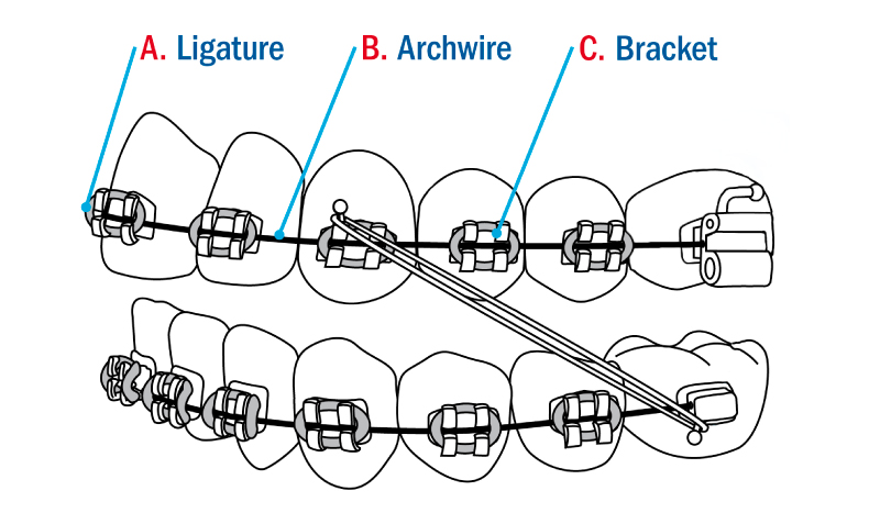 Metal Braces Components 