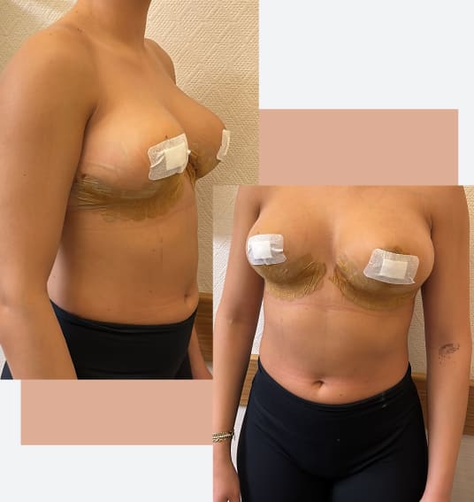 Breast Uplift