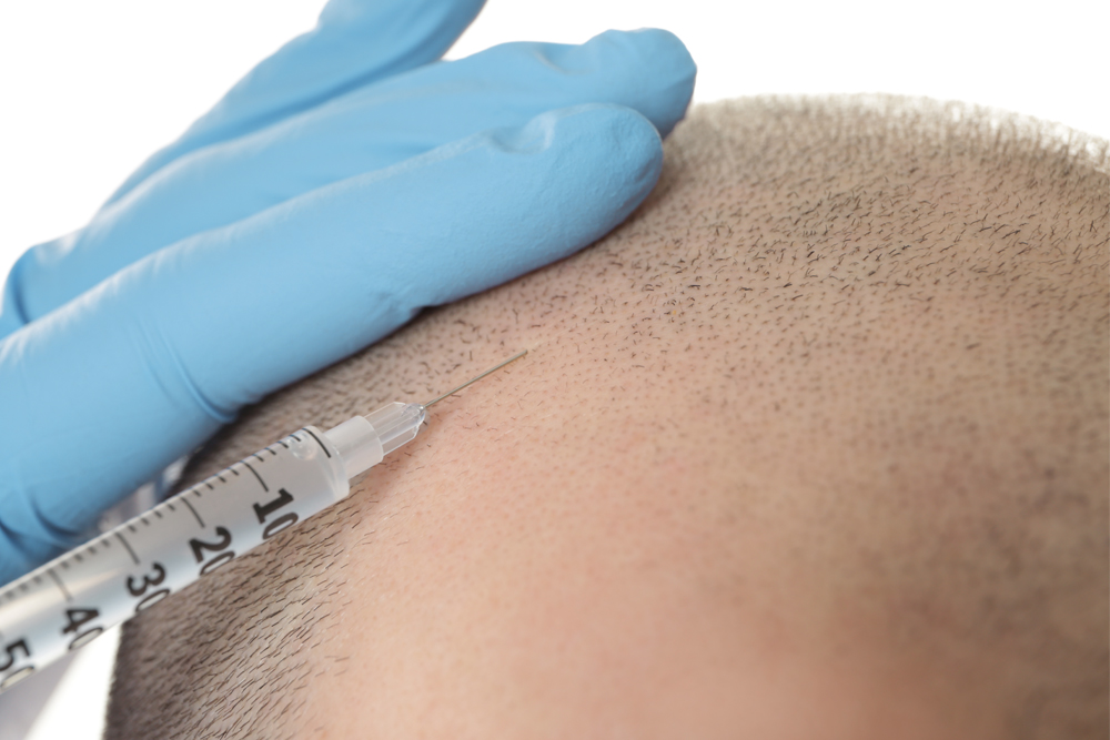 Tratamiento con células madre para el cabello 4 StemCells Celulas madre HT Cómo funcionan las células madre en el trasplante de cabello | MCAN Health