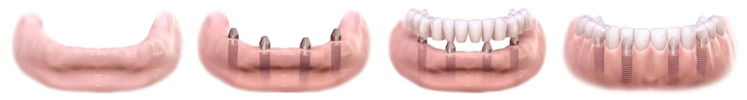 Step by step all on 4 dental implant procedure