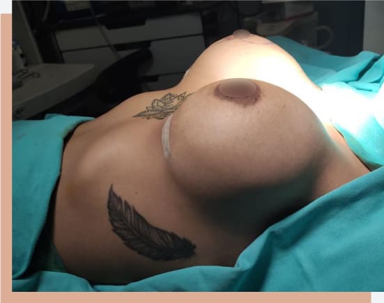 Expectation after breast implant procedure