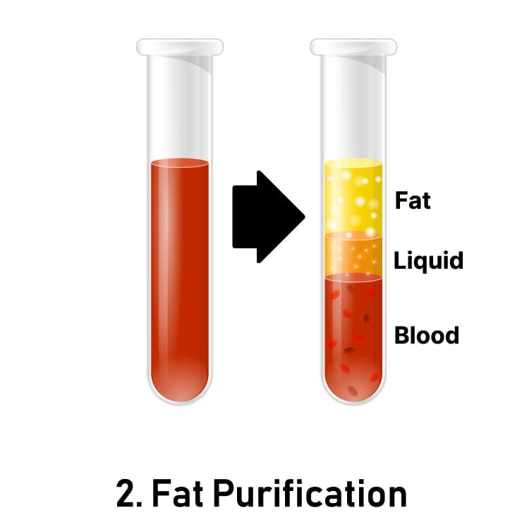 BBL Fat Purification