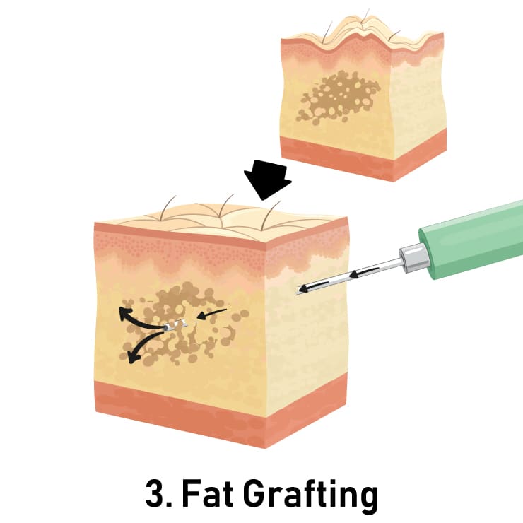 Fat Grafting BBL