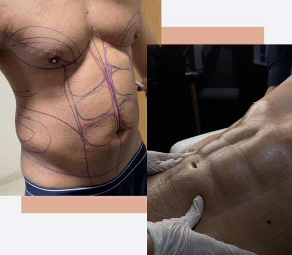 Patients’ Liposuction Expectations