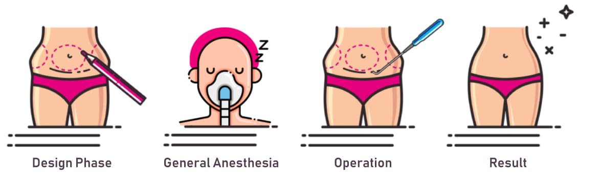 Fettabsaugung Schritte Operation