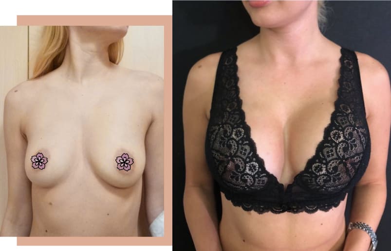 breast enlargement in turkey