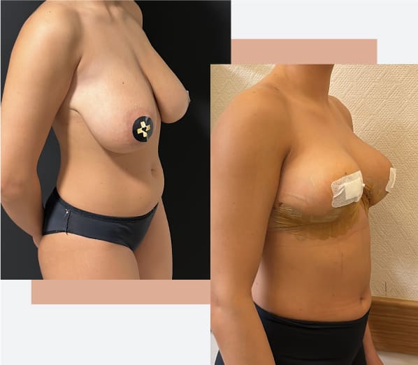 Breast reduction treatment