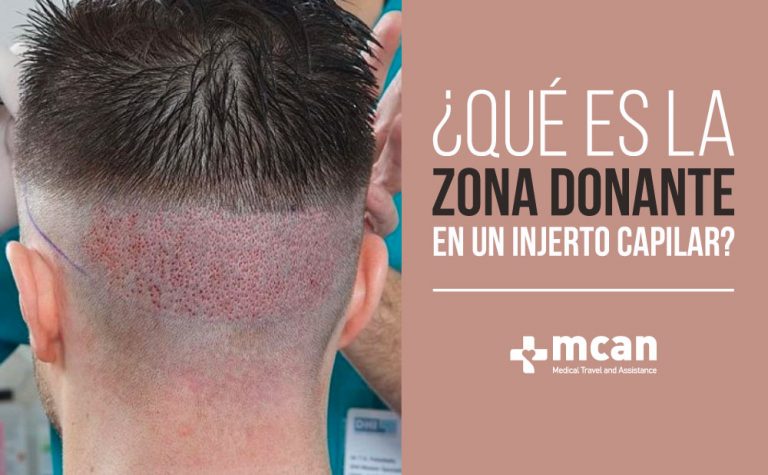 ¿Qué es la Zona Donante en un Injerto Capilar? 2 zona donante blog for web Zona donante en un injerto capilar | MCAN Health Blog