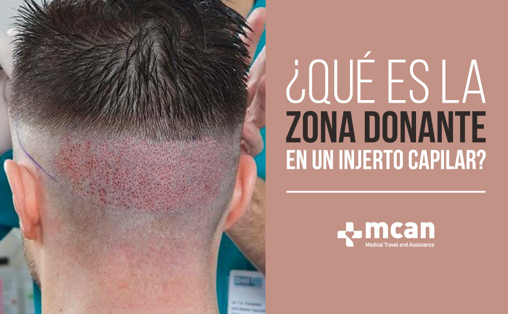 Zona donante en un injerto capilar | MCAN Health Blog