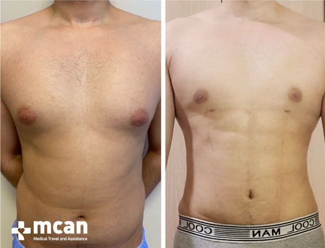 gynecomastia before and after