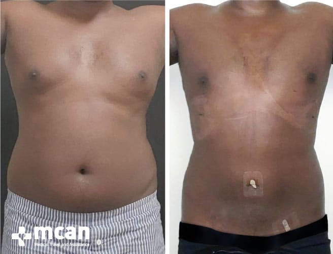 before and after gynecomastia Turkey