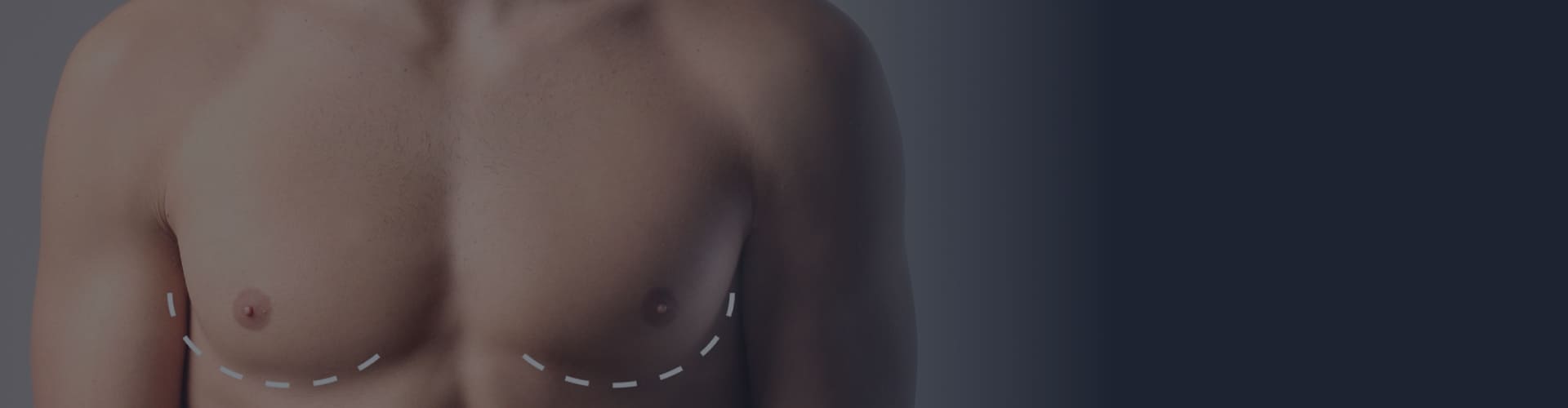nude photos of female stages of puberty Gynecomastia Surgery Turkey | MCAN Health