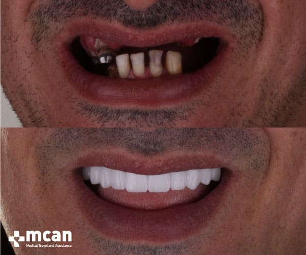 all on 4 dental implants procedure outcomes