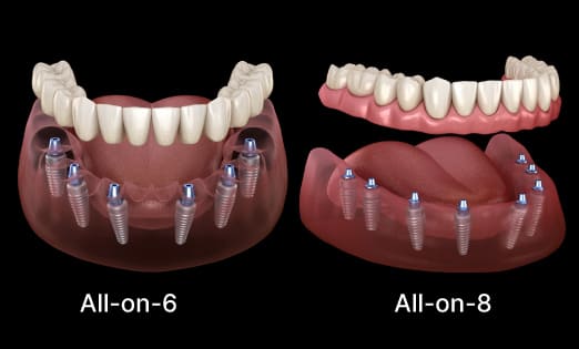 All on 6 and All on 8 dental implants