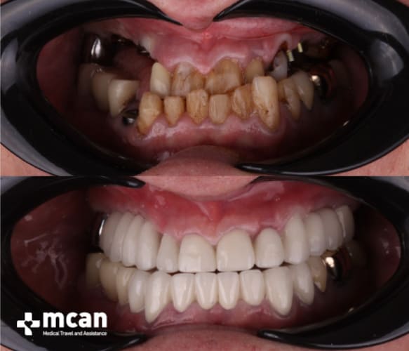 all on 4 dental implants turkey before and after