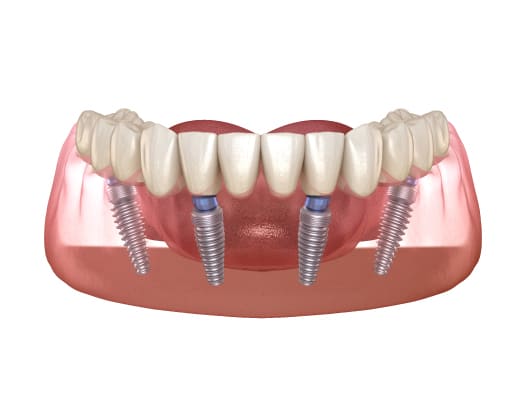 All-on-4 dental implants Turkey