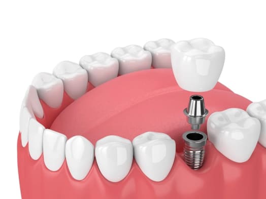 Endosteal dental implants