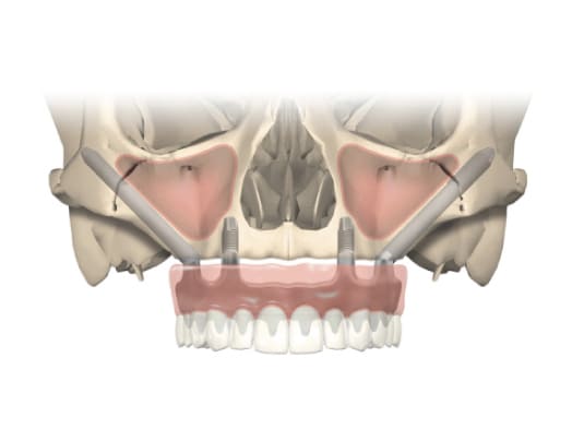 Zygomatic dental implants