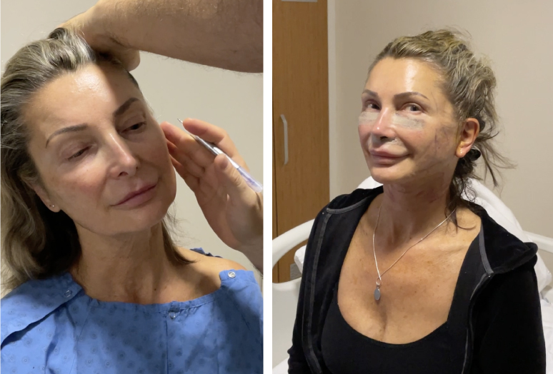 Facelift Turkey  Rhytidectomy Surgery Cost 2024